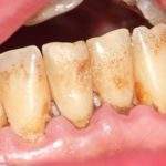 10 consejos para prevenir la placa en los dientes