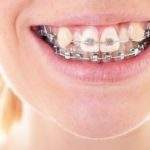 3 formas de corregir los dientes deformes y torcidos