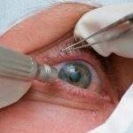 3 operaciones oculares que son muy comunes hoy en día