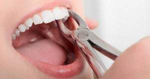 4 motivos comunes para extraer un diente