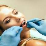 4 pasos del procedimiento para colocar brackets dentales