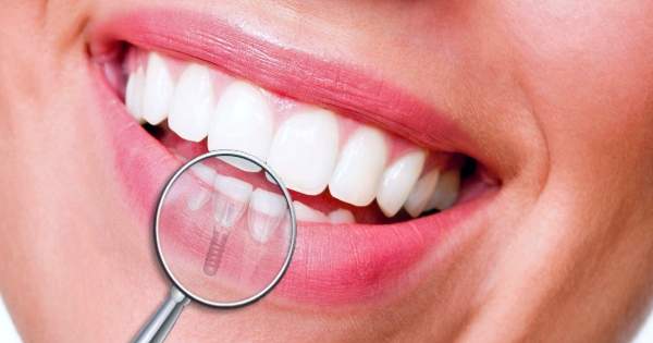 4 posibles complicaciones del implante dental