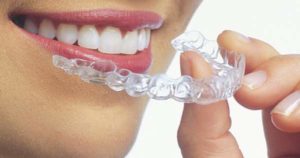 5 preguntas para tu ortodoncista sobre Invisalign