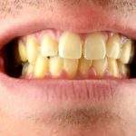 6 razones por las que tus dientes se ponen amarillos