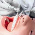 7 beneficios de la limpieza dental ultrasónica