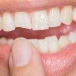 7 recomendaciones en caso de una fractura dental