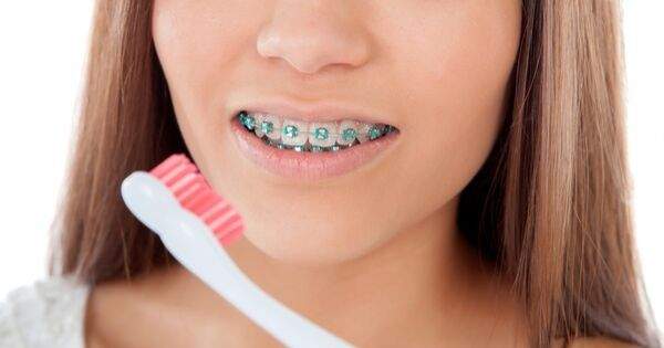 8 piezas que conforman los brackets dentales