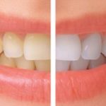 9 razones que provocan la decoloración dental