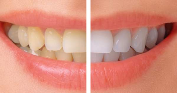 9 razones que provocan la decoloración dental