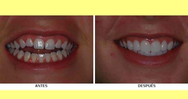 Carilla vs Corona Dental