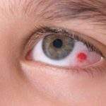 Causas, tipos y tratamiento de la úlcera corneal