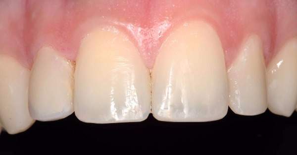 Científicos regeneran dientes con células de las encías