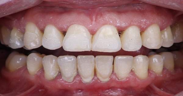 ¿Cómo funciona la limpieza dental con ultrasonido?