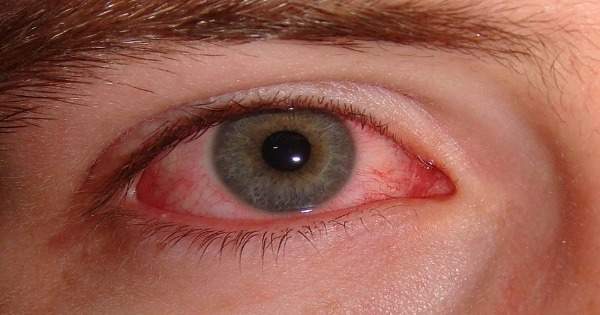 Cómo tratar las alergias en los ojos