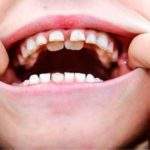 ¿Cómo tratar un diente en el paladar?
