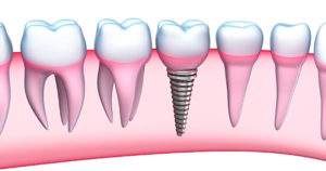 Conoce el proceso de colocación de los implantes dentales