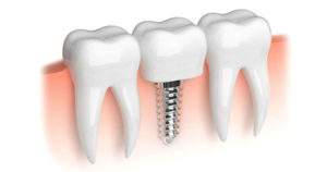 ¿Conoces el funcionamiento de los implantes dentales cortos?
