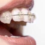 Consideraciones que debes conocer sobre la ortodoncia