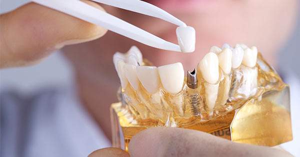 Cosas que debes saber sobre los Implantes dentales
