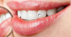 ¿Cuáles son los procedimientos de los tratamientos dentales estéticos_