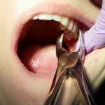 Cuídate: 9 causas frecuentes pérdida dental