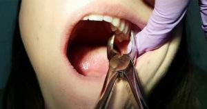 Cuídate 9 causas frecuentes pérdida dental