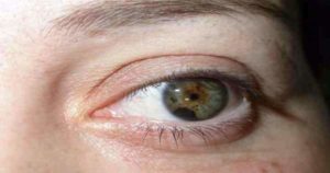 Descubre qué es y cómo tratar el melanoma ocular
