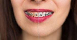 Diferencia entre blanqueamiento dental y limpieza dental