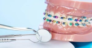Efecto de elásticos intermaxilares en ortodoncia