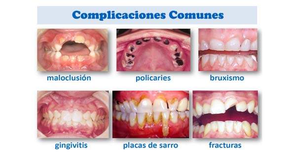 Enfermedades Bucales Dentales Comunes