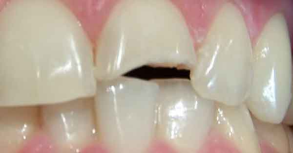 Fractura de dientes