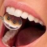Innovación en tratamientos dentales: brackets linguales