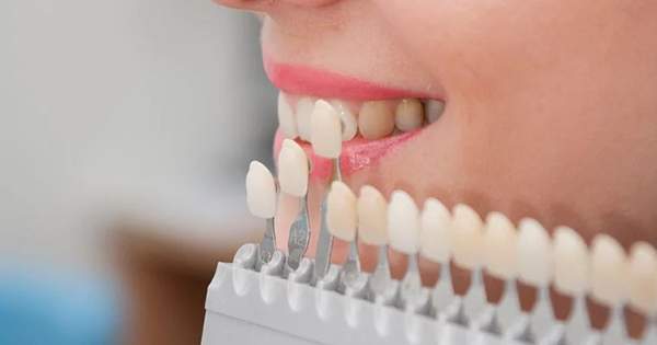 Los pros y contras de las carillas dentales, ¿valen la pena?