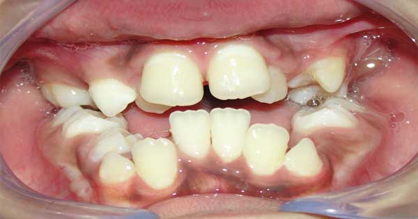 Maloclusion Dental en Niños