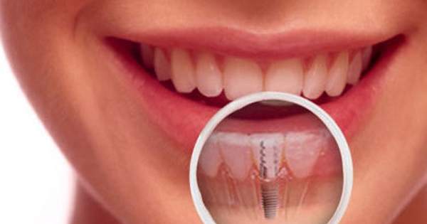 Opciones de tratamiento si has perdido un diente frontal