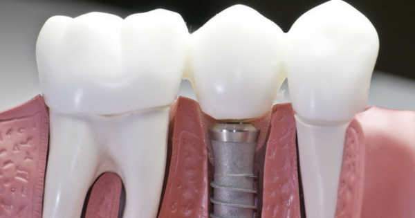Osteoporosis e Implantes Dentales