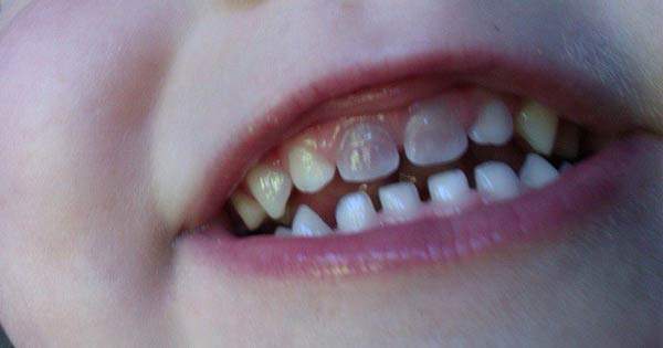 ¿Por qué mi hijo tiene un diente descolorido?
