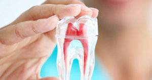 Preguntas frecuentes sobre la endodoncia