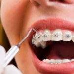 ¿Pueden los brackets provocar la caída de los dientes?