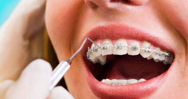 ¿Pueden los brackets provocar la caída de los dientes