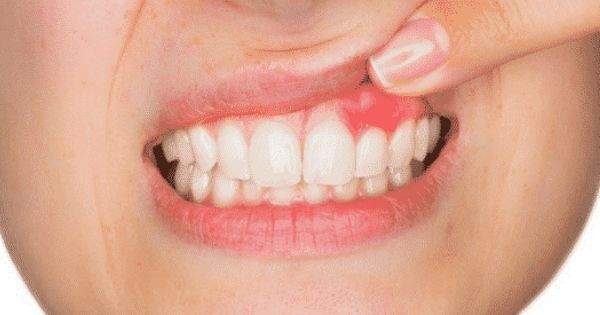¿Qué es un flemón dental?