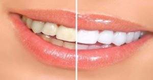 Razones para mantener los dientes blancos