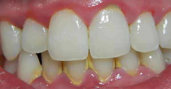 Sarro y Placa Dental