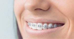 ¿Se pueden caer los dientes con los brackets?