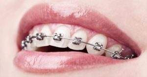 ¿Se pueden colocar brackets en las cara internas de los dientes?