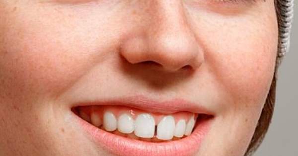 Separación entre dientes causas y tratamiento