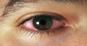 ¿Son realmente necesarios los antibióticos para tratar el ojo rojo?