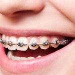 Tips para proteger tus dientes con brackets