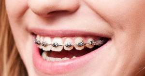Tips para proteger tus dientes con brackets