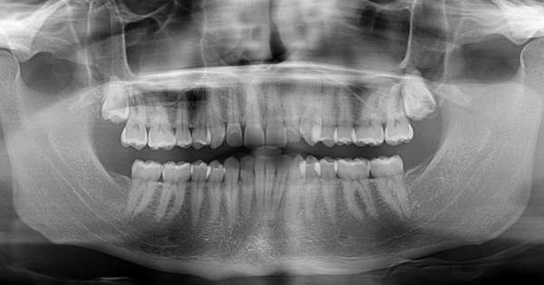 Ventajas de la radiografía panorámica en ortodoncia